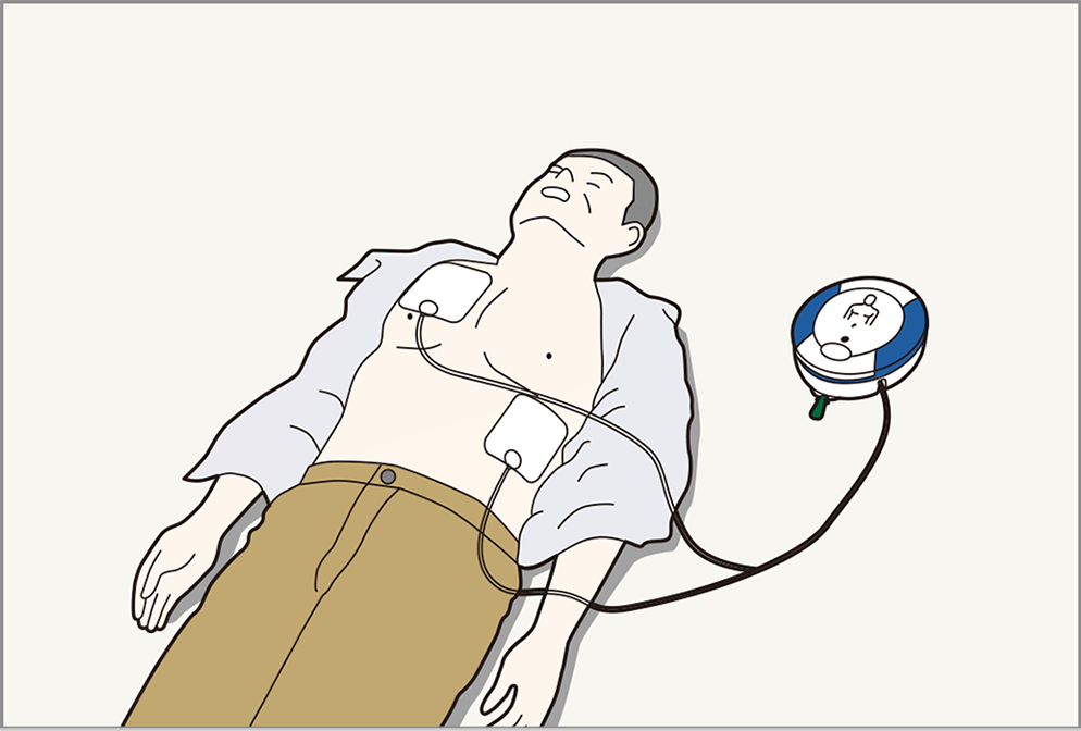 5.到着したAEDを速やかに装着